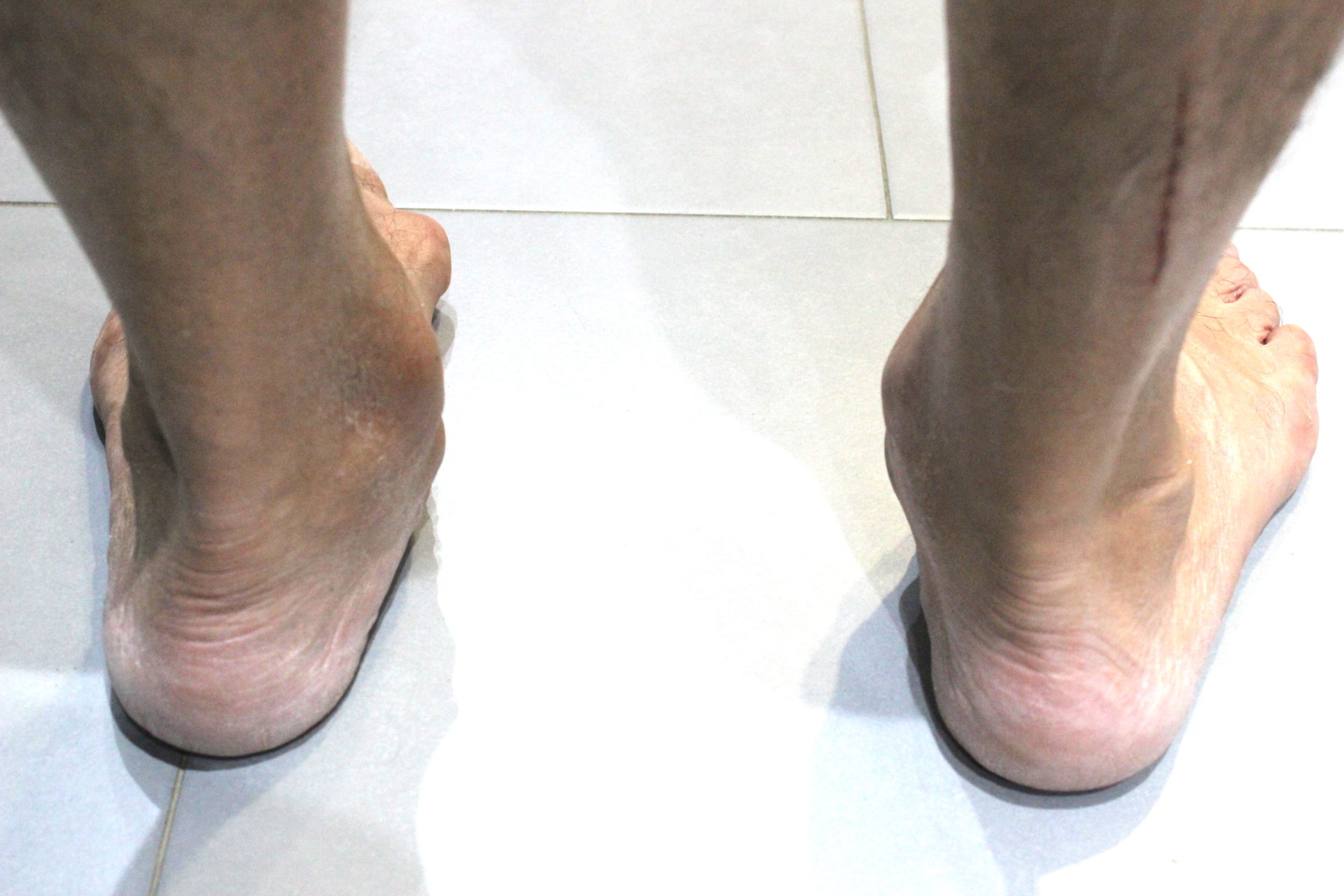 ¡Me duele el tobillo en la parte interna! Biomecánica Martínez